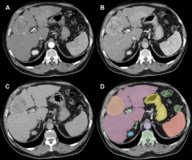 Visual representations of sample axial contrast-enhanced CT images and segmentations: (A) arterial phase, (B) portal venous phase, (C) delayed phase, and (D) segmented tumor with multiple organ masks, respectively.