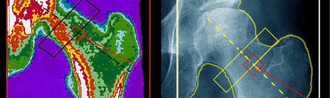 Side-by-side bone densitometry scan and X-ray of a hip bone.