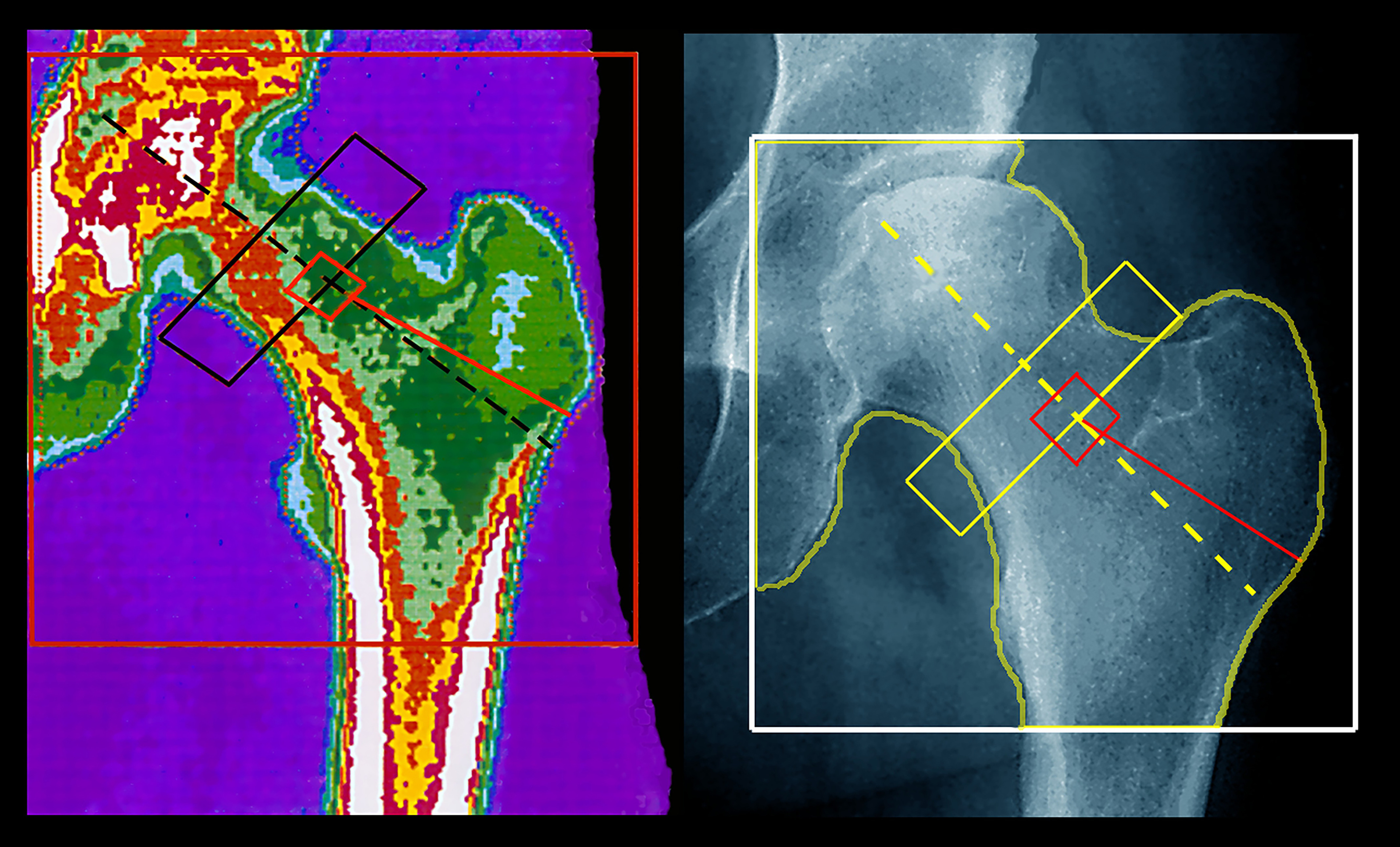 Side-by-side bone densitometry scan and X-ray of a hip bone