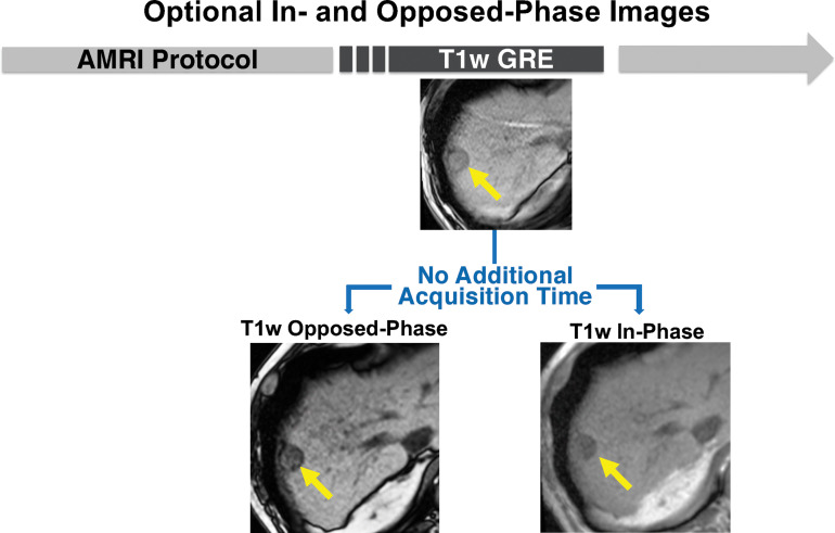 In-phase and opposed-phase chemical shift MRI can be performed simultaneously with Dixon T1-weighted (T1w) gradient-recalled-echo (GRE) MRI. The in- and opposed-phase sequences are performed to identify pathologic (intravoxel) fat content of tissues by showing a decrease in signal intensity on the opposed- phase images compared with the in-phase images. T1-weighted fat-suppressed GRE MR images show decreased signal intensity of the 2.5-cm mass (arrows) in segment 7-8. This sequence pair can be performed as part of any of the abbreviated MRI (AMRI) strategies, without additional acquisition time.