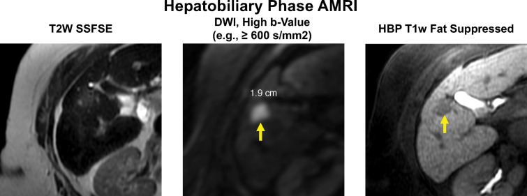 Example of an HBP abbreviated MRI (AMRI) protocol for HCC screening and surveillance. Axial MR images in a 78-year-old woman with HCV cirrhosis show a new 1.9-cm hypointense observation in segment 5 (arrows) with mild hyperintensity on the T2-weighted (T2W) and DWI MR images, and hypointensity on the HBP T1-weighted (T1w) fat-suppressed MR image. This study was considered positive for suspected HCC, and the patient was referred for diagnostic imaging. SSFSE = single-shot fast spin-echo.