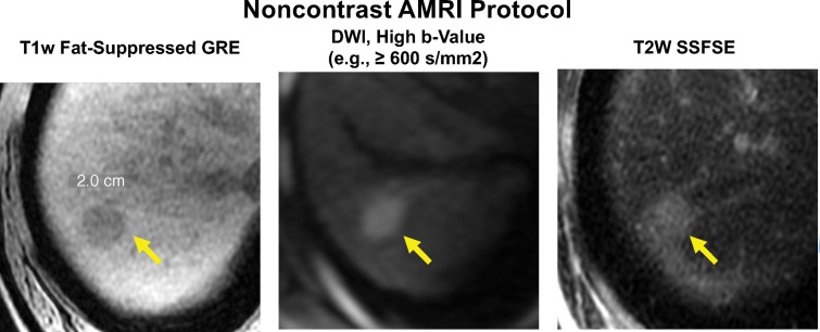 Abbreviated MRI protocol for HCC screening and surveillance. Nonenhanced abbreviated MR images in a 62-year-old man with HCV cirrhosis. A 2.0-cm hypointense observation (arrow) is seen in segment 7-8 on the T1-weighted (T1w) fat-suppressed gradient-recalled-echo (GRE) MR image, with restricted diffusion on the high b-value DWI MR image and moderate hyperintensity on the T2-weighted (T2w) steady-state fast spin-echo (SSFSE) MR image. This study was considered positive for suspected HCC.