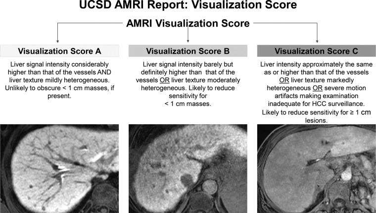 Standardized reporting of abbreviated MRI (AMRI) for HCC surveillance with HBP contrast agent. The optimal visualization score shows the liver parenchyma with considerably higher signal intensity than that of the vessels. An image quality score of A is unlikely to obscure masses smaller than 1 cm, if present.