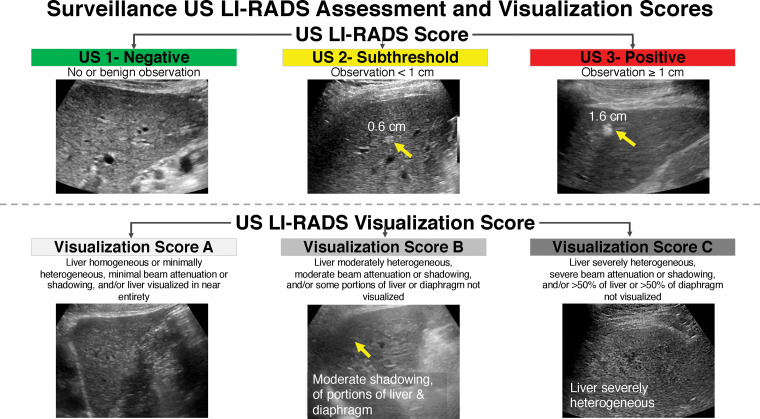 US LI-RADS assessment and visualization scores for surveillance. Positive screening US results (suspected malignant liver lesion ≥1 cm) prompt diagnostic imaging with multiphase contrast-enhanced CT, MRI, or contrast-enhanced US for further characterization. Diagnostic follow-up examinations are interpreted by using the LI-RADS CT, MRI, or contrast-enhanced US diagnostic algorithms. The visualization score indicates whether the study is limited by liver steatosis, a poor acoustic window, or other factors. Although the AASLD does not recommend additional imaging in patients with limited US findings, many physicians opt for alternative surveillance strategies in these instances, such as MRI or CT.