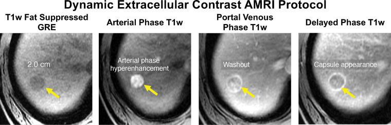 Abbreviated MRI (AMRI) protocol for HCC screening and surveillance. Axial dynamic extracellular contrast-enhanced T1-weighted (T1w) MR images in a 62-year-old man with HCV cirrhosis show a 2.0-cm observation (arrows) in segment 7 or 8 that appears hypointense and shows hyperenhancement on the arterial phase MR image, washout on the portal venous phase MR image, and a capsule appearance on the delayed phase MR image. This finding meets the criteria for LR-5, and this study was considered positive for suspected HCC. GRE = gradient-recalled echo.