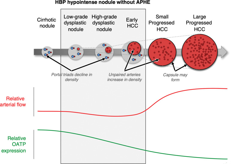 Hepatocarcinogenesis and timing of associated imaging features at HBP and arterial phase MRI. Apparent hypointensity in the HBP occurs because early progression to HCC results in decreased OATP transporter function before development of vascular alterations. A minority of HCCs (approximately 5%) show increased OATP expression and may appear hyperintense on HBP images. HBP imaging may allow detection of additional lesions, including small HCCs and early HCCs that are not visible on images from any other sequence. Because OATP expression decreases during carcinogenesis before complete neoarterialization, some HCCs may be first visible on HBP images as hypointense nodules, before they develop vascular alterations. (Reprinted, with permission from the ACR, reference 37.)