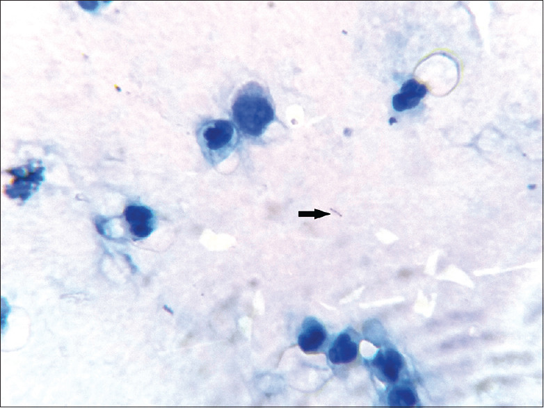 Role of Bronchoscopic Cytology in Diagnosis of Pulmonary Lesions - PMC