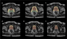 Six axial T2-weighted MRI images (a-f) showing segmentation of prostate (red), seminal vesicles (green), and peri-prostatic adipose tissue (yellow) from base to apex of prostate gland.