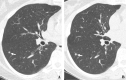 (A, B) Two annual repeat low-dose CT scans in a woman who was 60 years
old at baseline enrollment in 1999. At baseline enrollment, she was
currently smoking and had a 30-pack-year smoking history. No nodules were
identified on baseline low-dose CT scans. On the sixth annual low-dose CT
scan (B), a right lower lobe solid nodule (arrow) measuring 4.5 mm in
maximum diameter was identified. The nodule could be identified in
retrospect on the prior annual CT scan (arrow in A), when it measured 2.0 mm
in maximum diameter. Estimated tumor volume doubling time was 161 days.
Lobectomy was performed 2 months later, and diagnosis of stage 1aN0M0
moderately differentiated adenocarcinoma measuring 6.0 mm in maximum
diameter was made. Expert pathologic panel review (22) of the pathologic
specimen updated the diagnosis to adenocarcinoma with mixed subtype (80%
acinar, 20% bronchoalveolar carcinoma components) with 5 mm of
invasion.