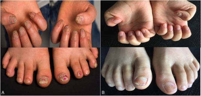 Idiopathic 20-nail dystrophy - PMC