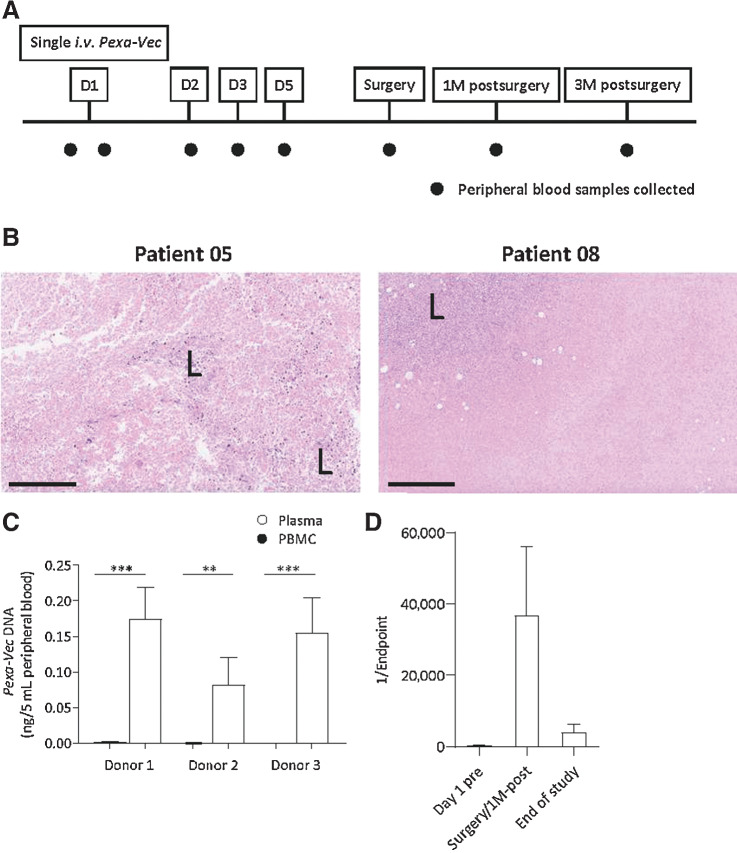 Figure 1. Pexa-Vec peripheral blood carriage. A, Trial schema showing the timing [day (d); month (M)] of Pexa-Vec infusion and collection of translational blood samples. B, H&E staining of tumor sections from patients 05 and 08 showing areas of necrosis. “L” indicates lymphocytic infiltrate. Bars, 400 μm. C, qPCR quantification of Pexa-Vec in the plasma or PBMCs of three healthy donors following ex vivo addition of virus to whole blood. Data are shown as mean + SEM ng DNA in PBMCs or plasma extracted from an initial 5 mL peripheral blood. **, P < 0.01; ***, P < 0.001 by unpaired t tests; n = 9. D, Neutralizing antibodies to Pexa-Vec in patient serum following intravenous infusion. Plot shows mean + SEM pre-virus, peak at surgery/1M after and end of study titers in n = 9 patients.