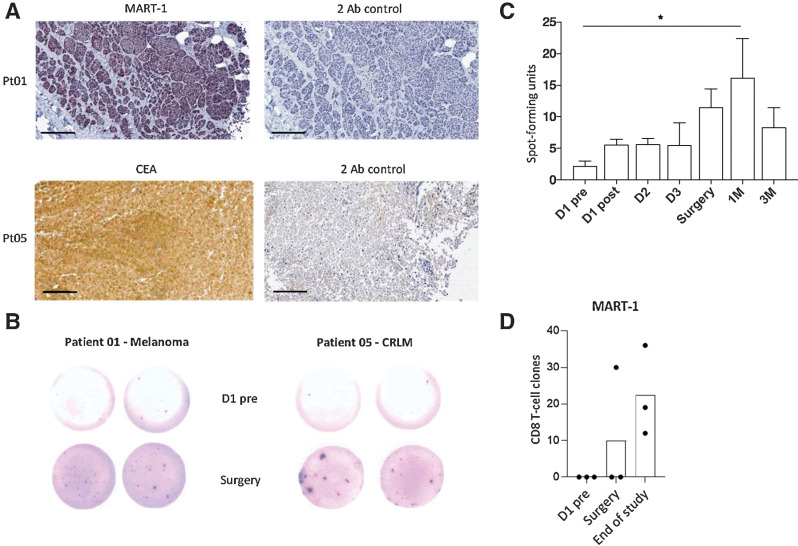 Figure 5. T-cell functional anticancer responses. A, Representative IHC of patient tumors showing MART-1 (patient 01) and CEA (patient 05) expression (purple and brown, respectively), with corresponding secondary antibody controls (2 Ab). Bars, 200 μm. B, Representative ELISpot images from patients 01 and 05 at the indicated timepoints. PBMCs were stimulated using MART-1 and CEA overlapping peptide pools, respectively. Duplicate wells are shown for each timepoint. Data are shown as SFU per well; each spot represents an IFNγ-secreting T cell. C, Cumulative CEA and MART-1 IFNγ responses from all 9 patients via ELISpot. Data are shown as mean + SEM SFU/well. *, P < 0.05 by paired t tests; n = 7–9, depending on sample availability. D, Estimated numbers of CD8 T cells that belong to specific MART-1 TAA clones. Data shown for melanoma patients 01, 03, and 04.