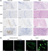 Figure 2. Pexa-Vec detection in resected CRLM specimens. A, The presence of Pexa-Vec in surgical tissue was assessed by IHC following intravenous infusion. Representative slides from 4 patients shows vaccinia protein (brown), secondary antibody-alone controls (2 Ab), and H&E stains in consecutive sections. B, Tissue core biopsies taken from resected CRLM and background liver samples from patients undergoing standard surgery outside the clinical trial. Patient samples were treated with Pexa-Vec-GFP or PBS prior to confocal fluorescent imaging. Images shown are for 1 of 10 representative patients. All bars indicate 200 μm.