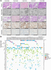 Figure 1. Establishment and characterization of patient-derived organoids from advanced lung adenocarcinoma. A, Representative H&E and IHC stained images of NSCLC organoids and their parental tumor tissues. The tumor organoids were positive for TTF-1, an adenocarcinoma marker, and negative for Calrectinin, a mesothelial cell marker. NSCLC organoids recapitulated morphologic and histologic features of original tumor tissues. H&E, brightfield, and IHC images are shown. Scale bar, 100 μm. B, Genomic landscape in 61 patient-derived organoids of advanced lung adenocarcinoma. Organoids were derived from TKI-naïve NSCLC, TKI-resistant NSCLC, NSCLC without driver oncogenes, and normal tissue. Clinically relevant somatic alterations selected from the TARGET database are shown. Actionable targets and clinically relevant driver genes based on the NCCN guideline (version 8.2020) and the lung adenocarcinoma TCGA database are indicated (left). Type of alteration is indicated by color codes. The percentage of organoids harboring the indicated alterations are shown (right).
