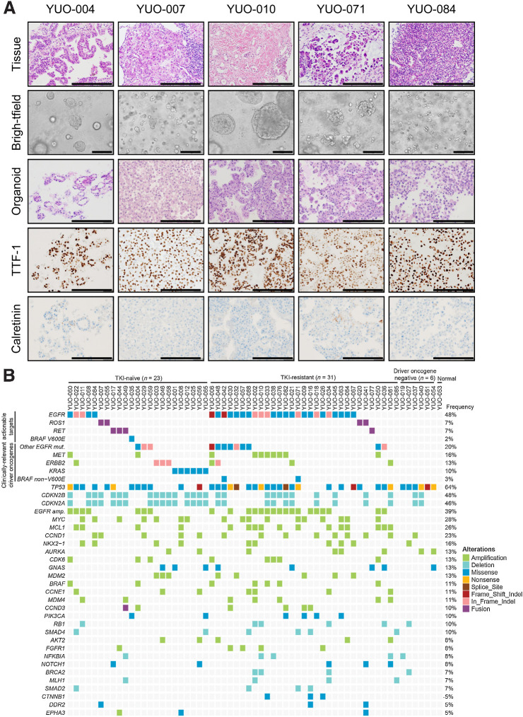 Figure 1. Establishment and characterization of patient-derived organoids from advanced lung adenocarcinoma. A, Representative H&E and IHC stained images of NSCLC organoids and their parental tumor tissues. The tumor organoids were positive for TTF-1, an adenocarcinoma marker, and negative for Calrectinin, a mesothelial cell marker. NSCLC organoids recapitulated morphologic and histologic features of original tumor tissues. H&E, brightfield, and IHC images are shown. Scale bar, 100 μm. B, Genomic landscape in 61 patient-derived organoids of advanced lung adenocarcinoma. Organoids were derived from TKI-naïve NSCLC, TKI-resistant NSCLC, NSCLC without driver oncogenes, and normal tissue. Clinically relevant somatic alterations selected from the TARGET database are shown. Actionable targets and clinically relevant driver genes based on the NCCN guideline (version 8.2020) and the lung adenocarcinoma TCGA database are indicated (left). Type of alteration is indicated by color codes. The percentage of organoids harboring the indicated alterations are shown (right).