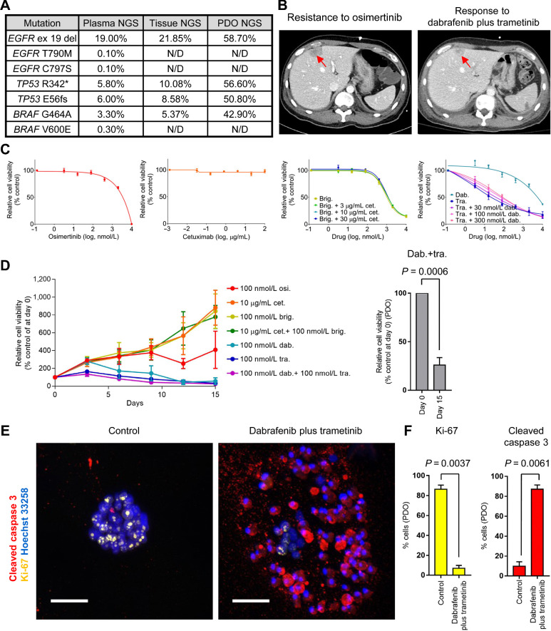 Figure 4. PDOs recapitulate a clinical response to dabrafenib/trametinib combination therapy against EGFR exon 19 deletion plus BRAF G464A mutation. A, Summary of NGS analyses in liquid and tissue biopsies and YUO-071. B, CT scans showing tumor (red arrows) at disease progression to osimertinib (left) and after dabrafenib plus trametinib combination therapy (right) in a patient from which YUO-071 was generated. C, YUO-071 was treated with the indicated concentrations of osimertinib (far left), cetuximab (left), brigatinib with or without cetuximab at the indicated concentrations (right), and dabrafenib alone, trametinib alone, or trametinib plus dabrafenib at the indicated concentrations (far right) for 5 days. D, YUO-071 was exposed to osimertinib, dabrafenib, trametinib, dabrafenib plus trametinib, cetuximab, brigatinib, cetuximab plus brigatinib at the indicated concentrations for 15 days (left). Relative cell viability of YUO-071 before (day 0) and after the long-term exposure (day 15) to dabrafenib plus trametinib is shown on the right panel. E, Representative immunofluorescence images of indicated molecules in YUO-071 treated with control or 100 nmol/L dabrafenib in combination with 100 nmol/L trametinib for 5 days. Scale bar, 100 μmol/L. F, Bar graphs showing quantification of Ki-67–positive cells (left) and cleaved caspase 3–positive cells (right) in each group from E. In C, D, and F, data are presented as the mean ± SEM (n = 3; two-tailed Student t test). N/D, none detected.