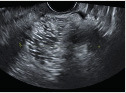 graphic file with name FVVinObGyn-13-107-tg005.jpg