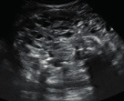 graphic file with name FVVinObGyn-13-107-tg025.jpg