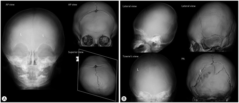 Craniosynostosis : Updates in Radiologic Diagnosis - PMC