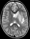 (a–c) Axial T2-weighted (a) and fluid-attenuated inversion recovery (b) MRI scans show diffuse hyperintense signal and edema of caudate nucleus head, putamen, anterior limb of internal capsule, and parts of external capsule and insula on left side, with corresponding low values on axial apparent diffusion coefficient map (c), in keeping with an acute infarction. (d) Maximal intensity projection reformatted image from time-of-flight MR angiography shows focal irregular narrowing and banding of proximal left M1 segment of middle cerebral artery with slightly reduced distal flow in middle cerebral artery (arrows).