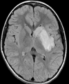 (a–c) Axial T2-weighted (a) and fluid-attenuated inversion recovery (b) MRI scans show diffuse hyperintense signal and edema of caudate nucleus head, putamen, anterior limb of internal capsule, and parts of external capsule and insula on left side, with corresponding low values on axial apparent diffusion coefficient map (c), in keeping with an acute infarction. (d) Maximal intensity projection reformatted image from time-of-flight MR angiography shows focal irregular narrowing and banding of proximal left M1 segment of middle cerebral artery with slightly reduced distal flow in middle cerebral artery (arrows).