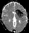 (a–c) Axial T2-weighted (a) and fluid-attenuated inversion recovery (b) MRI scans show diffuse hyperintense signal and edema of caudate nucleus head, putamen, anterior limb of internal capsule, and parts of external capsule and insula on left side, with corresponding low values on axial apparent diffusion coefficient map (c), in keeping with an acute infarction. (d) Maximal intensity projection reformatted image from time-of-flight MR angiography shows focal irregular narrowing and banding of proximal left M1 segment of middle cerebral artery with slightly reduced distal flow in middle cerebral artery (arrows).