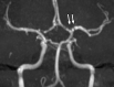 (a–c) Axial T2-weighted (a) and fluid-attenuated inversion recovery (b) MRI scans show diffuse hyperintense signal and edema of caudate nucleus head, putamen, anterior limb of internal capsule, and parts of external capsule and insula on left side, with corresponding low values on axial apparent diffusion coefficient map (c), in keeping with an acute infarction. (d) Maximal intensity projection reformatted image from time-of-flight MR angiography shows focal irregular narrowing and banding of proximal left M1 segment of middle cerebral artery with slightly reduced distal flow in middle cerebral artery (arrows).