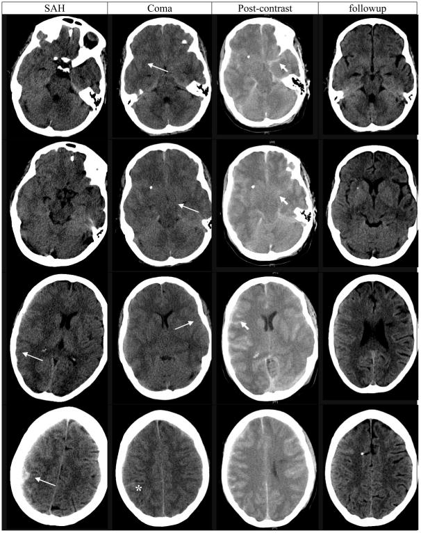 Transient Life-threatening Cerebral Edema In A Patient With Systemic 