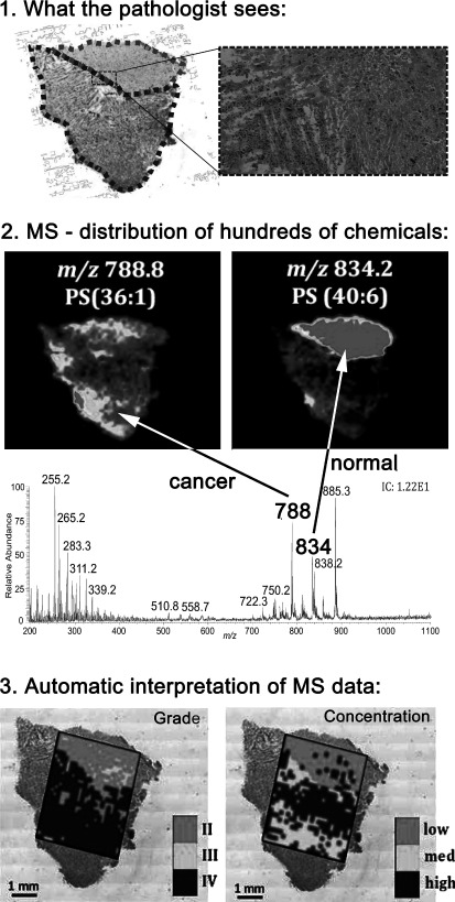 Fig. 3. Classifying human brain tumors by lipid imaging with mass spectrometry. Top: What the pathologist sees: Optical image of the H&E-stained adjacent section. Center: MS-distribution of hundreds of chemicals: Tumor heterogeneity and infiltration is assessed by DESI-MS imaging. Negative ion mode DESI-MS ion images of glioblastoma G33 showing the distribution of PS(36 : 1) at m/z 788 and PS(40 : 6) at m/z 834. Bottom: Classification results can be visualized as a class image using a color code corresponding to each class and registered to the optical image of an adjacent section. Grade and concentration classification for heterogeneous sample G33. Adapted from ref. 59 with permission. © 2012 American Association for Cancer Research.