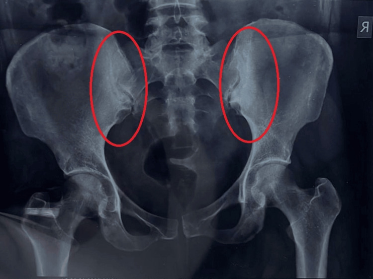 Osteitis Condensans Ilii: A Case Report - PMC