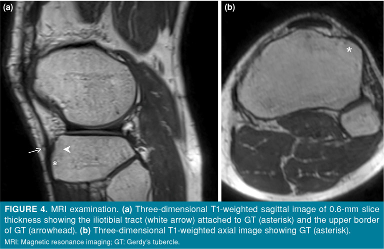 Gerdy’s tubercle as a novel anatomical landmark for the proximal tibial ...