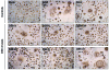 Fig. (3). Syncytium formation in MDM induced by <i>nef</i>-deleted viruses