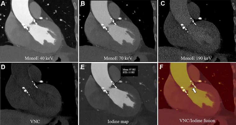 Contrast-enhanced photon-counting detector CT images of SAPIEN 3 valve with hypoattenuated leaflet thickening in an 82-year-old female patient following transcatheter aortic valve replacement. (A–C) Virtual monoenergetic (mono-E) images at different kiloelectron voltage levels in the sagittal plane. A and B show hypoattenuated leaflet thickening at the former left coronary cusp and less pronounced thickening of the right coronary cusp. (D) Virtual noncontrast (VNC) reconstruction and (E) iodine map. (F) Fused iodine and VNC maps show no iodine uptake in the coronary cusps (white arrow).