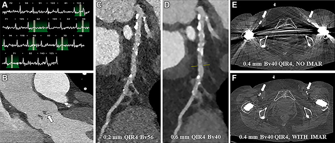 Photon-counting detector CT scan for pre–transcatheter aortic valve replacement planning in an 81-year-old female patient (with contrast material). (A) Electrocardiogram shows a highly irregular heart rate was present at the time of scanning. (B) Contrast-enhanced visualization of the aortic annulus and native aortic valve in the sagittal plane with sharp delineation of the leaflets and a small calcification in the nodule of Arantius (white arrow). (C) Ultra-high-resolution image shows the coronary arteries (Bv56 kernel, multiplanar reformatted image). (D) Conventional reconstructions at 0.6-mm section thickness (Bv40 kernel) for comparison (multiplanar reformatted image). (E, F) Axial reconstructions at the level of the femoral arteries (arrows) without (E) and with (F) iterative metal artifact reduction (IMAR) reconstruction. QIR = quantitative iterative reconstruction.