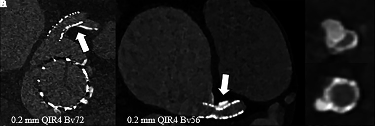 Contrast-enhanced photon-counting detector CT images in an 85-year-old female patient following transcatheter aortic valve replacement with a stent in the left main coronary artery. (A) Ultra-high-resolution (UHR) image of the valve and stent (axial plane). UHR image shows (B) incomplete stent expansion (arrow) with (C, D) axial reconstructions perpendicular to the stent axis. QIR = quantitative iterative reconstruction.