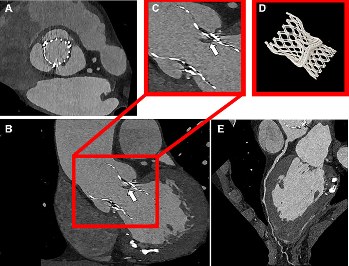 Ultra-high-resolution (UHR) photon-counting detector CT images show valve-in-valve transcatheter aortic valve replacement with hypoattenuated leaflet thickening in a 72-year-old male patient scanned with contrast medium. (A) Axial UHR image (Bv56 kernel, quantum iterative reconstruction strength 4). (B) CT image shows hypoattenuating leaflet thickening (white arrow). (B, C) Surgical valve and transcatheter heart valve frames are sharply depicted in the sagittal plane. (D) Three-dimensional volume-rendered image. (E) Coronary artery calcifications in left anterior descending artery (multiplanar reformatted images).