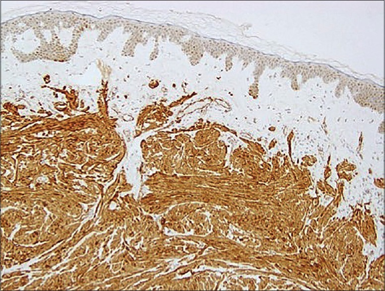 Reed's Syndrome - PMC