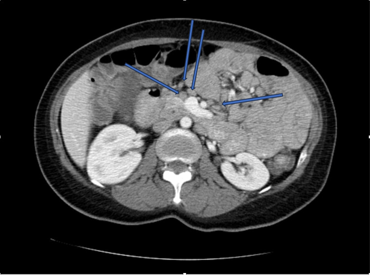 Treatment resistant immunoproliferative small intestinal disease ipsid