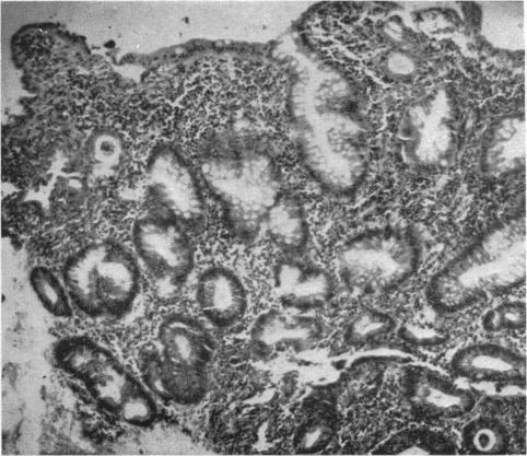 Case 1, Biopsy 2