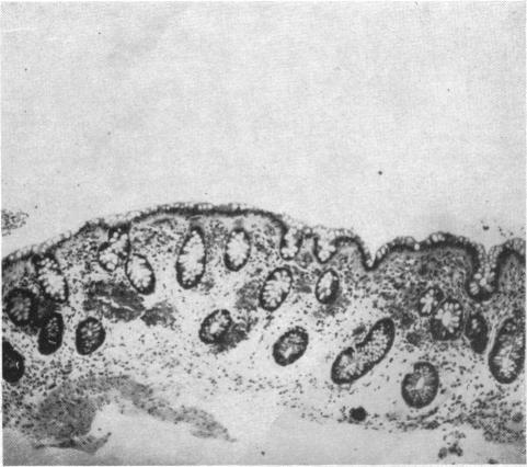 Case 2, Biopsy 6