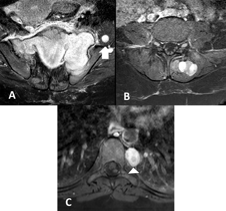 Intraosseous malignant peripheral nerve sheath tumor of the sacrum in a ...