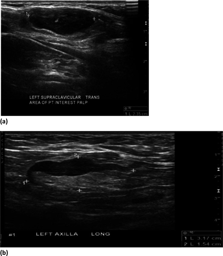 (a) 37-year-old female with palpable left supraclavicular adenopathy. Grayscale ultrasound images of the left supraclavicular region demonstrates a single, cortically thickened lymph node correlating with the region of palpable interest. (b) 37-year-old female with palpable left axillary adenopathy. Grayscale ultrasound images of the left axilla demonstrate multiple, cortically thickened, level 1 axillary lymph nodes correlating with the region of palpable interest and mammographic abnormality.