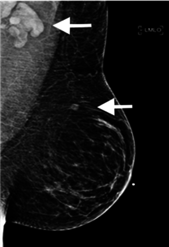 37-year-old female with palpable left supraclavicular adenopathy. Diagnostic mediolateral oblique mammogram of the left breast demonstrates prominent left axillary adenopathy and an intramammary lymph node (white arrows).