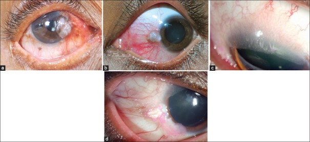 Tumors of the ocular surface: A review - PMC