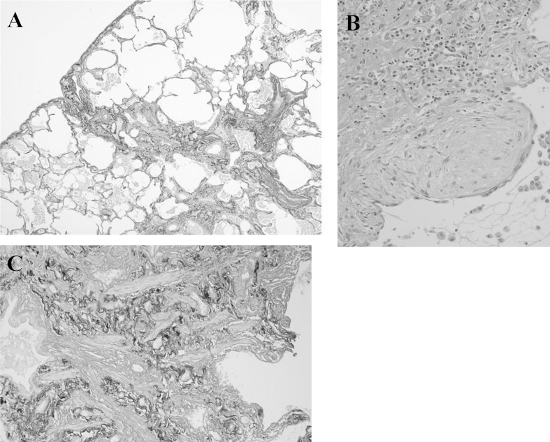 Microscopic polyangiitis preceded by combined pulmonary fibrosis and ...