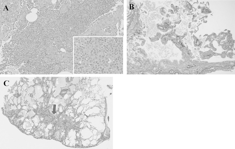 Microscopic polyangiitis preceded by combined pulmonary fibrosis and ...