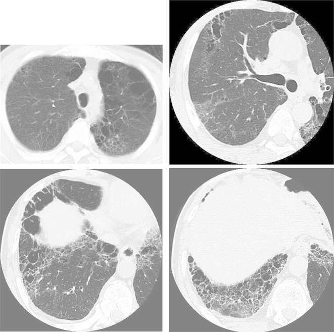 Microscopic polyangiitis preceded by combined pulmonary fibrosis and ...