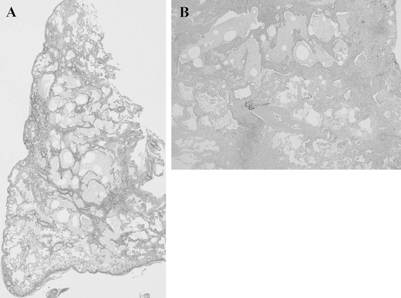 Microscopic Polyangiitis Preceded By Combined Pulmonary Fibrosis And 