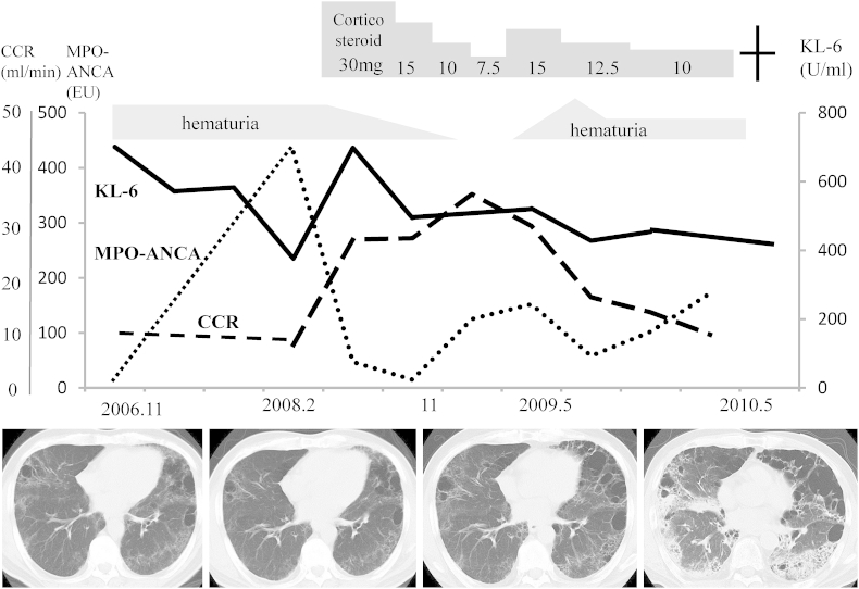 Microscopic polyangiitis preceded by combined pulmonary fibrosis and ...