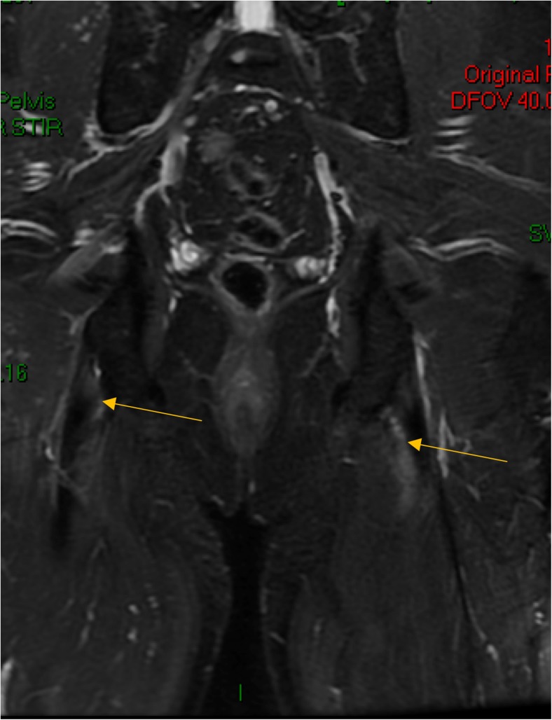 Enthesitis: Much More Than Focal Insertion Point Inflammation - PMC